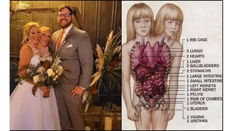 אנג וצ'אנג בנקר, "התאומים הסיאמיים המקוריים"